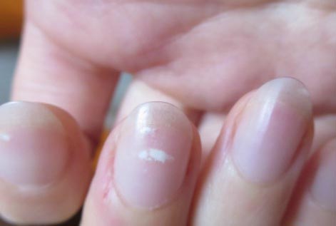 Khi thấy dấu hiệu bất thường ở ngón tay giữa nên đi khám ngay vì cảnh báo gan đang có vấn đề